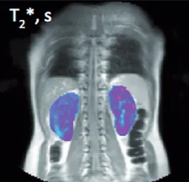 T2* maps in lupus nephritis