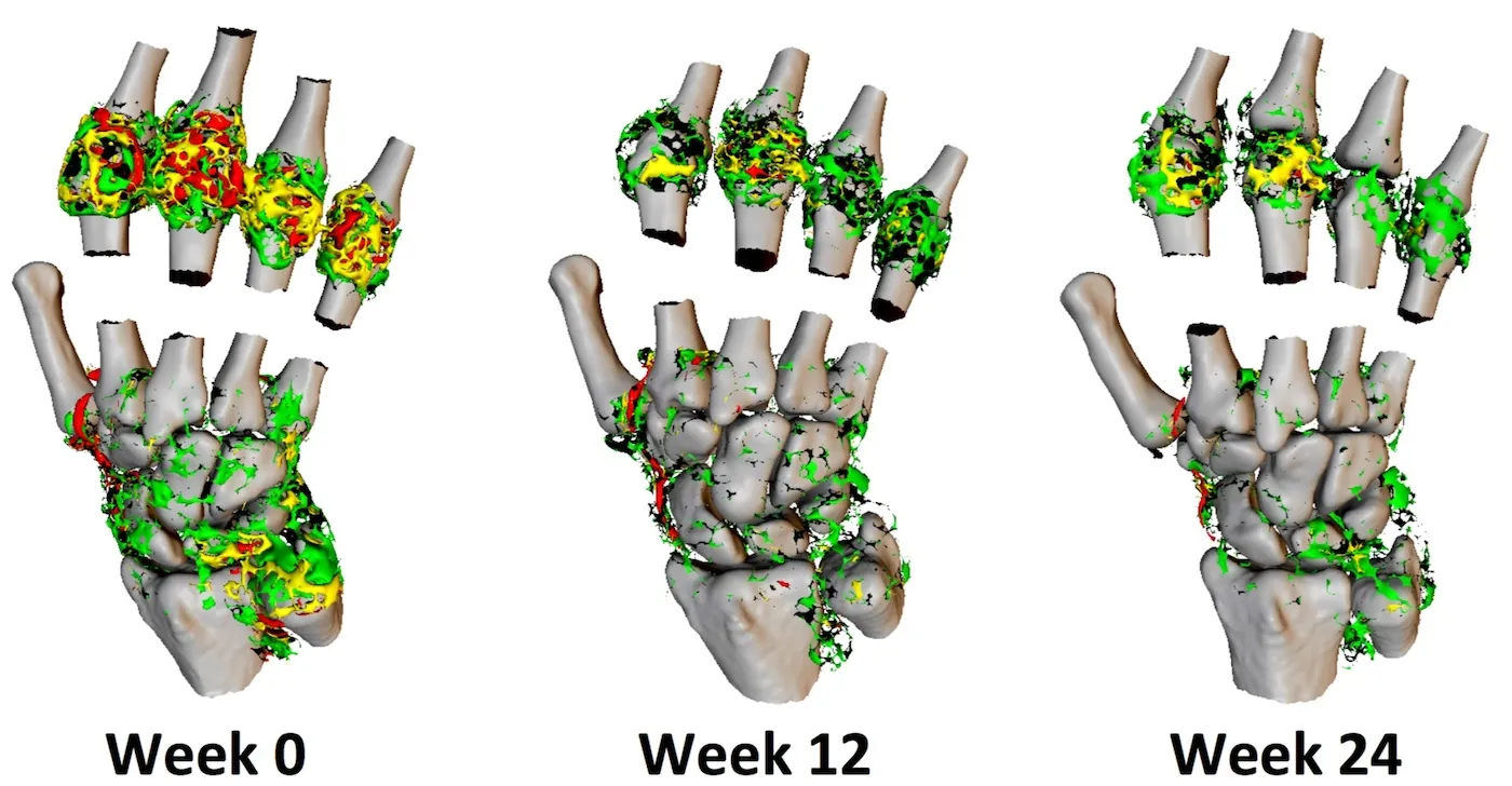DCE-MRI in inflammatory joint disease